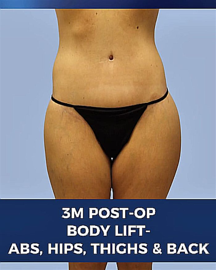 3 month post-op body lift — abs, hips, thighs and back