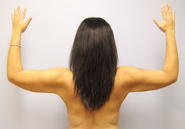 arm lift patient 1 before