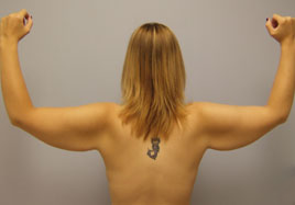 arm lift surgery patient 3 before