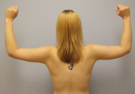 arm lift surgery patient 3 after