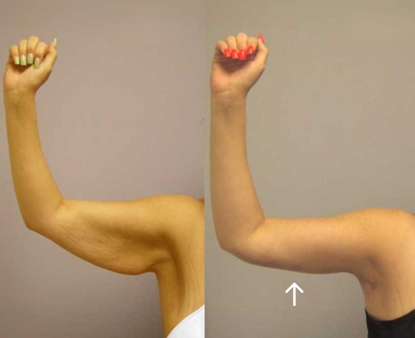 Scar placement after arm lift surgery patient before & after