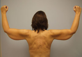 brachiolasty patient 2 before