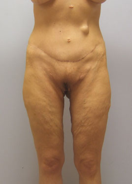 case20
