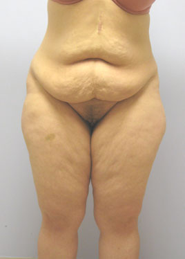 case25