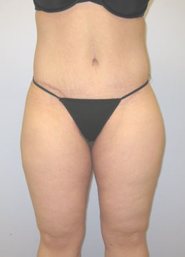 case25