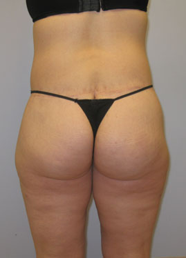 case25